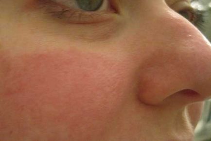 congestie venoasă cauze, tipuri, clasificare, semne, simptome, tratament (venoase) cauze congestie venoasă, tipuri, clasificare, semne, simptome, tratament