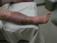 Și hiperemie arteriale venoase cauze, simptome și fiziopatologia (venoase) Venoasă și hiperemie arterială cauze, simptome si fiziopatologia