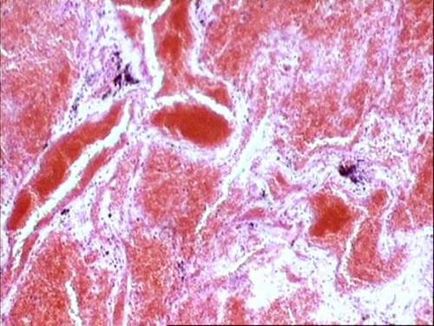 Venoasă și hiperemie arterială cauze, simptome si fiziopatologia (cauza) Venoasă și hiperemie arterială cauze, simptome si fiziopatologia