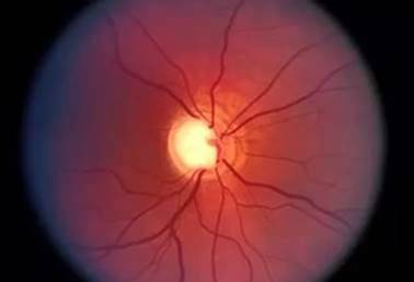 Și hiperemie arteriale venoase cauze, simptome și fiziopatologia (venoase) Venoasă și hiperemie arterială cauze, simptome si fiziopatologia