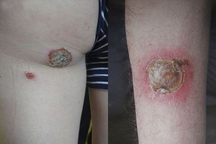 Ecthyma tipuri, cauze, simptome si tratamente ale bolii (dezvoltare) Ecthyma tipuri, cauze, simptome si tratamente ale bolii
