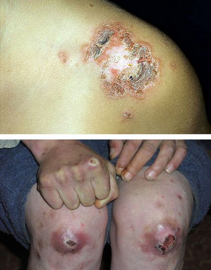 Ecthyma tipuri, cauze, simptome si tratamente ale bolii (ecthyma) Ecthyma tipuri, cauze, simptome si tratamente ale bolii