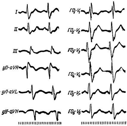 bloc intraventriculară, aritmii cardiace