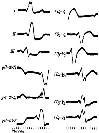 bloc intraventriculară, aritmii cardiace