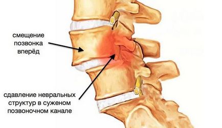 Repoziționa vertebrelor cervicale, br (eficienta viscere) Reducerea vertebrelor cervicale, w