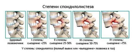 Repoziționa vertebrelor cervicale, br (vertebre) Reducerea vertebrelor cervicale, w