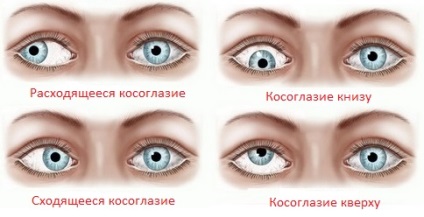 Alternând convergentă și strabism divergent (strabism) Alternarea convergentă strabism divergent și