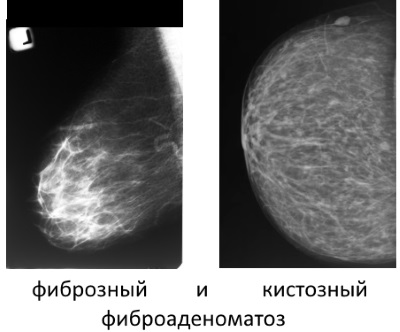 Fibroadenomatosis de san - ceea ce este și ce să facă (fibroadenomatosis) Fibroadenomatosis de san - ceea ce este și ce să facă
