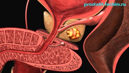 Prostatita calculoasa la barbati: cauze, simptome, diagnostic și tratament