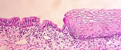 metaplazie scuamoasă (plat metaplazirovanny epiteliului) metaplazie scuamoasa