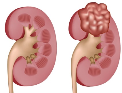 Cât de mulți trăiesc cu cancer metastatic - principalii factori care influențează (tumori secundare ale stomacului) Cât de mulți trăiesc cu cancer metastatic - principalii factori care influențează