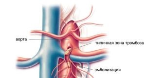tromboză arterială mezenteric - Cauze, Diagnostic si Tratament Clinica