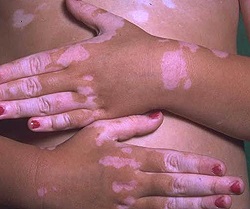 Vitiligo - cauze, simptome, diagnostic și tratament