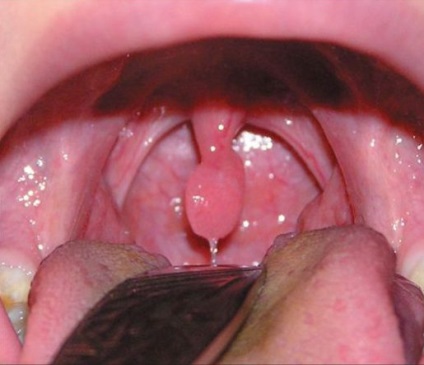 Inflamarea limbii în gât cauze, simptome si tratament uvulita