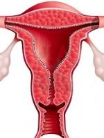 hiperplazia adenomatoasă endometrului (adenomatoasă) hiperplazia adenomatoasă a endometrului