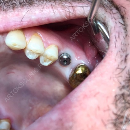 Implantarea dinților inferiori (implanturi mandibulare) (maxilarului) Implantarea dinților inferiori (implanturi mandibulare)