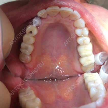 Implantarea dinților inferiori (implanturi mandibulare) (implantare dinți inferiori) Implantarea dinților inferiori (implanturi mandibulare)