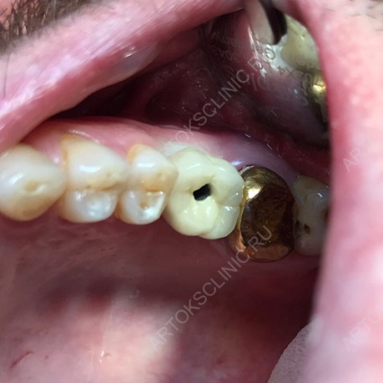 Implantarea dinților inferiori (implanturi mandibulare) (jos) Implantarea dinților inferiori (implanturi mandibulare)