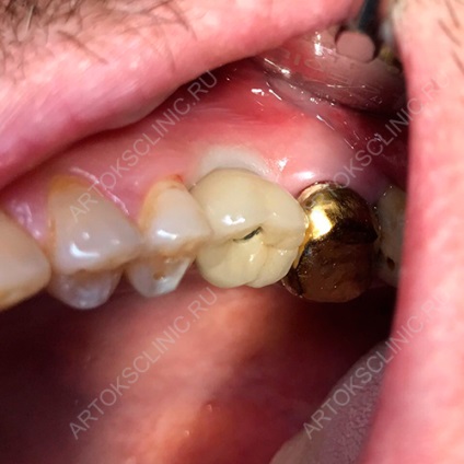 Implantarea dinților inferiori (implanturi mandibulare) (implantare) Implantarea dinților inferiori (implanturi mandibulare)