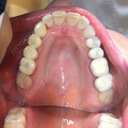 Implantarea dinților inferiori (implanturi mandibulare) (maxilarului inferior) Implantarea dinților inferiori (implanturi mandibulare)