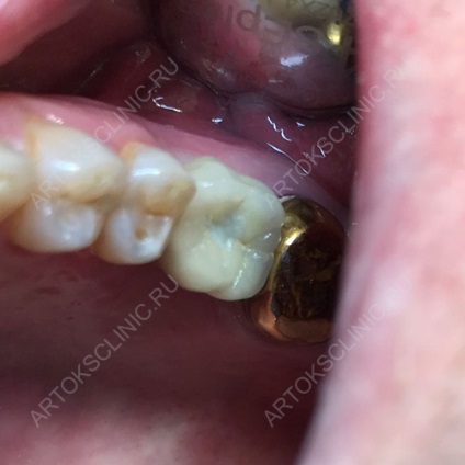 Implantarea dinților inferiori (implanturi mandibulare) (inferior) Implantarea dinților inferiori (implanturi mandibulare)