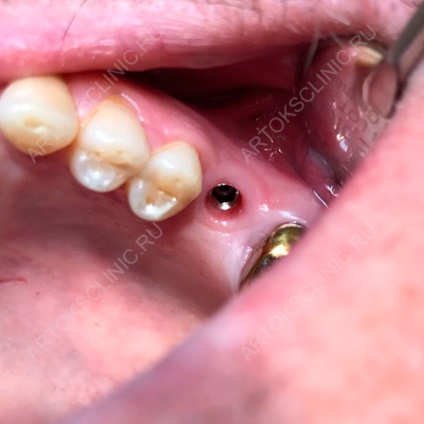 Implantarea dinților inferiori (implanturi mandibulare) (implantare dinți inferiori) Implantarea dinților inferiori (implanturi mandibulare)