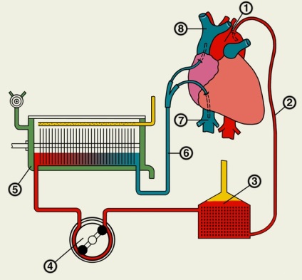 inima artificiala - ea (by-pass cardio-pulmonar) inima artificiala - un