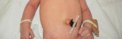 Cum să se ocupe de un buric nou-născut după naștere, în primele zile (cum să se ocupe de nou-născut buric cu un știft) Cum să se ocupe de un buric nou-născut după naștere, în primele zile