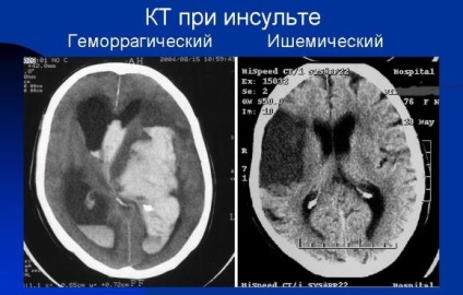 Tomografia computerizată (CT) a cursei cerebrale