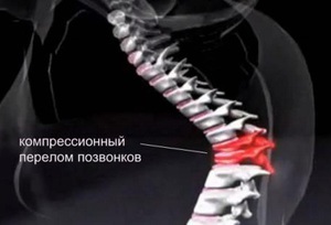 Tratamentul de compresie fracturi vertebrale in cauzele in varsta si diagnosticul, tratamentul și