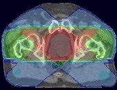 Melanomul - chimioterapie (chimioterapie) Melanomul - chimioterapie