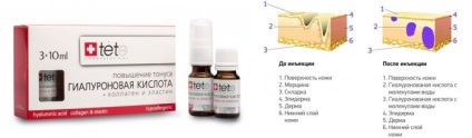 Mezoterapia - ce este, prețurile și recenzii (mezoterapie) Mezoterapia - ce este, prețurile și recenzii