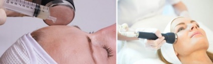 Mezoterapia - ce este, prețurile și comentarii (păr scade oprește acolo) Mezoterapia - ce este, prețurile și recenzii