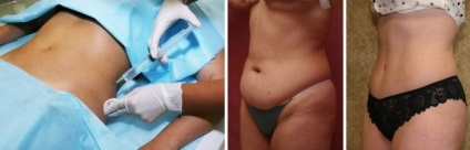 Mezoterapia - ce este, prețurile și comentarii (păr scade terminate) Mezoterapia - ce este, prețurile și recenzii