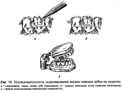 Modelarea ceara mucegai a coroanelor dintilor pe modele - un portal dentar bun, bun (Figura) Modelarea ceara mucegai a coroanelor dintilor pe modele - un portal dentar bun, bun