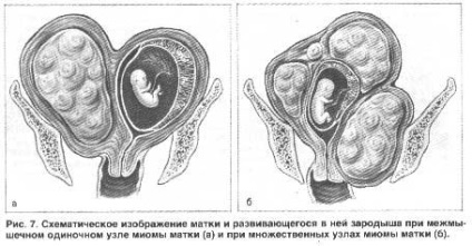 Pot face plajă cu fibrom uterin - Aflați mai multe! (Can) Pot face plajă cu fibrom uterin - Aflați mai multe!