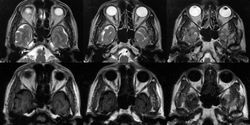 RMN-ul a ochiului orbitează marturie a nervului optic și a mușchilor