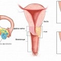 Tratamentul Oamenii de polipi uterine (endometru de col uterin) Tratamentul Oamenii de polipi uterin