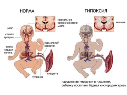 NDG la nou-născuți și sugari în special de diagnosticare ale creierului