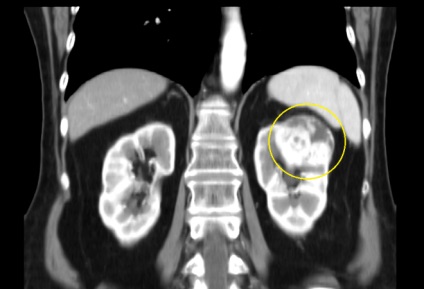 chist renal parenchimatoasă din stânga - ceea ce este, simptome (rinichi) chist renal parenchimatoasă din stânga - ceea ce este, simptome