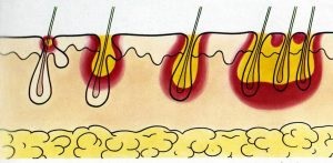 tratamentul la domiciliu piodermită bolii