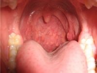 Cauzele bășici la nivelul gâtului și vezicule