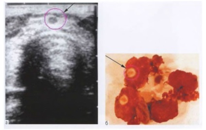 cancer tiroidian (prevenirea) cancer tiroidian