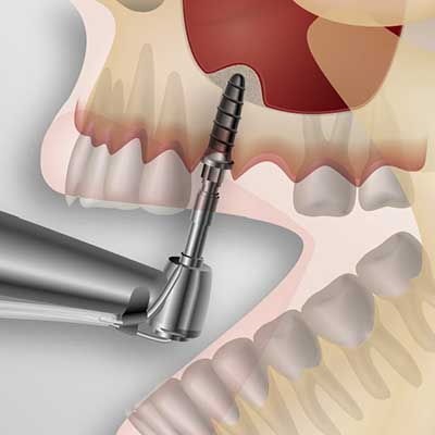 sinus lift în stomatologie (interior si exterior)