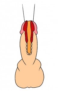 Strictura Ureta (tratamentul prostatitei) strictura Ureta