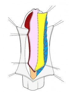 Strictura Ureta (urolog apel la domiciliu) strictura Ureta