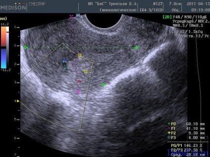 ecografie uter și fanere pregătirea pentru studiul de boli ale organelor feminine