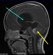 Ce este hidrocefalia creierului de înlocuire extern