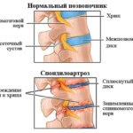 Gută Tratament remedii populare la domiciliu