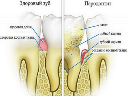 Tratamentul bolii periodontale la căi de atac acasă populare